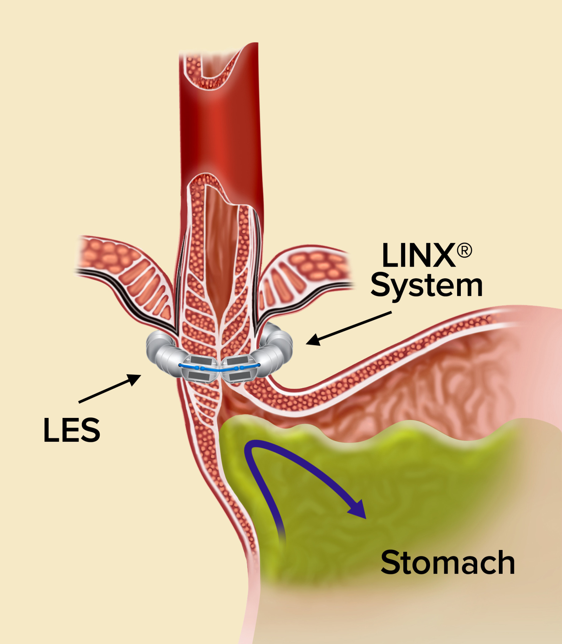 Acid Reflux