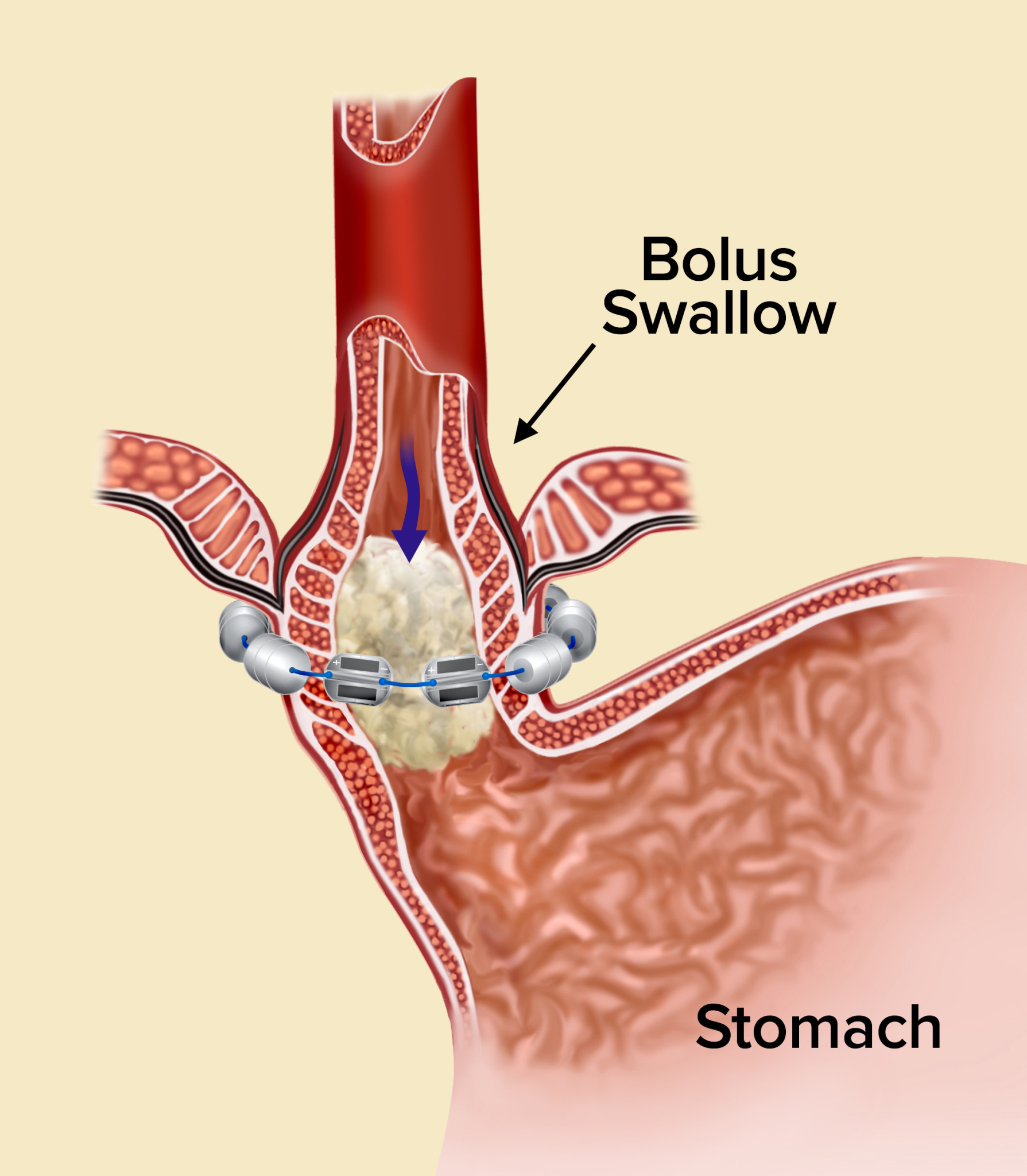 magnets stopping reflux