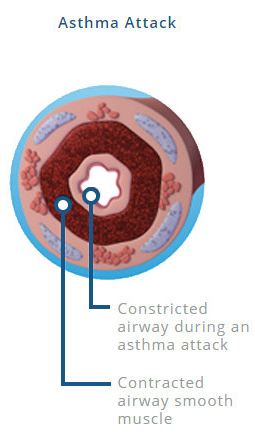 An airway during an asthma attack showing a constricted airway and contracted airway smooth muscle.