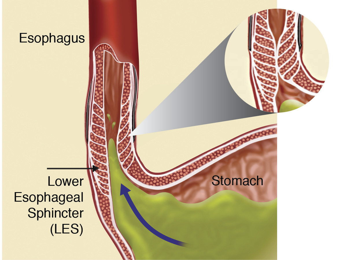 acid reflux treatment