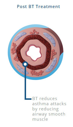 An airway post BT treatment showing how BT reduces asthma attacks by reducing airway smooth muscle.