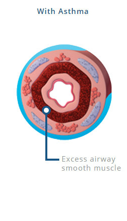 An airway with asthma indicating an excess airway smooth muscle.