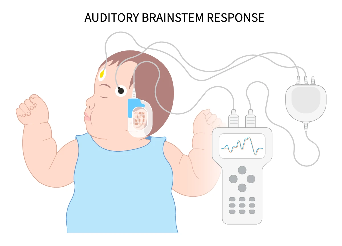 Auditory brainstem response test connected to an infant.