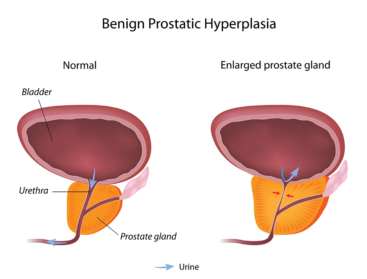 The image shows the difference between a normal prostate gland and an enlarged prostate gland