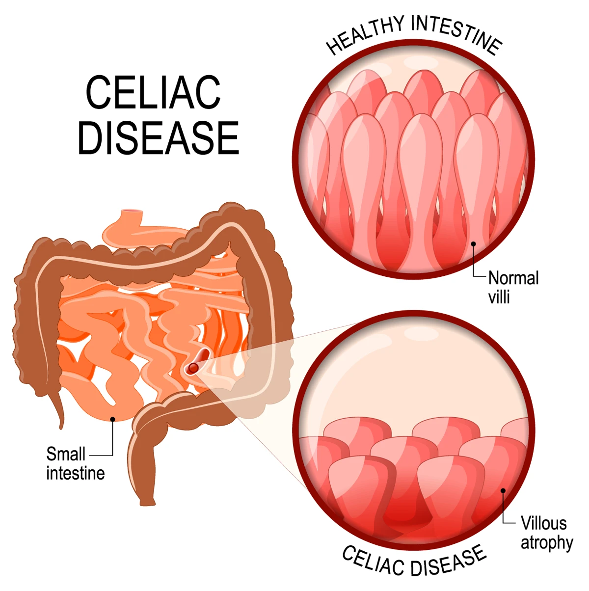 Healthy intestinal lining vs. villous atrophy