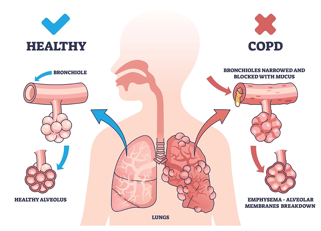 Illustration of a healthy lung and a lung affected by chronic bronchitis