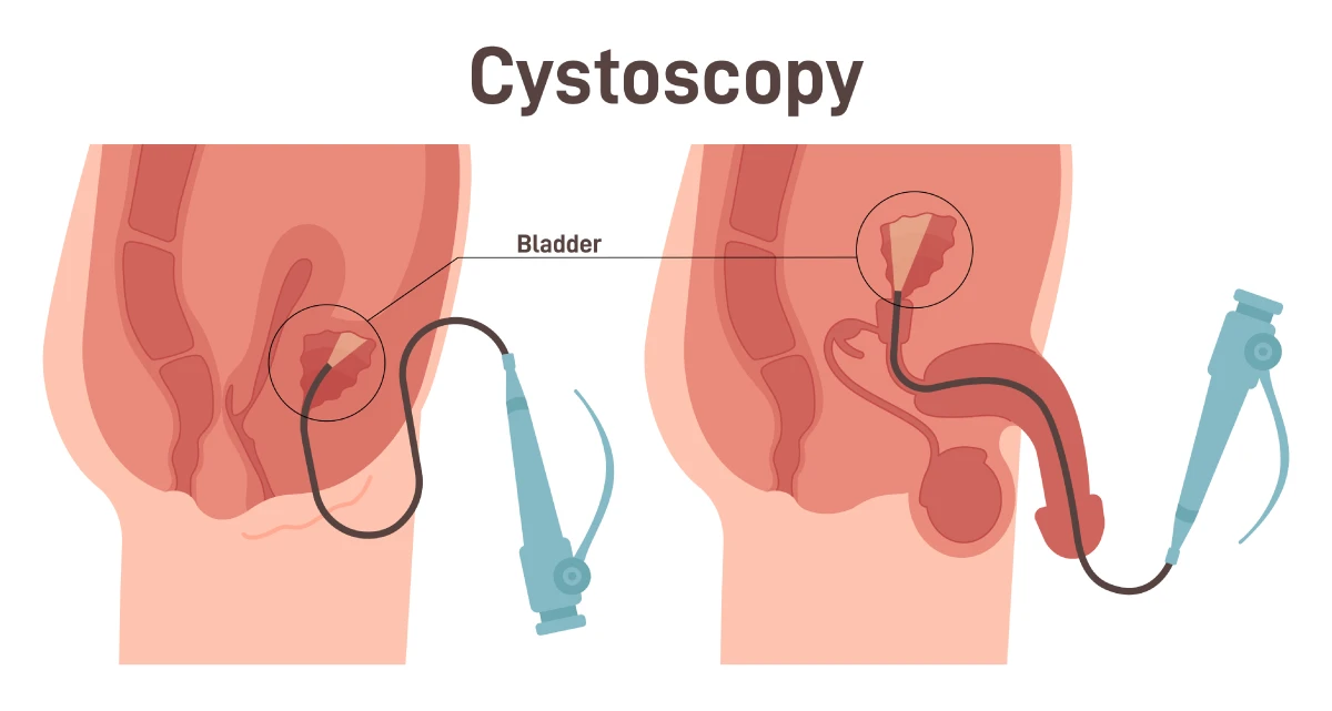 A cystoscopy performed on a woman and man with a flexible cystoscope  inserted into the patient's urethra.