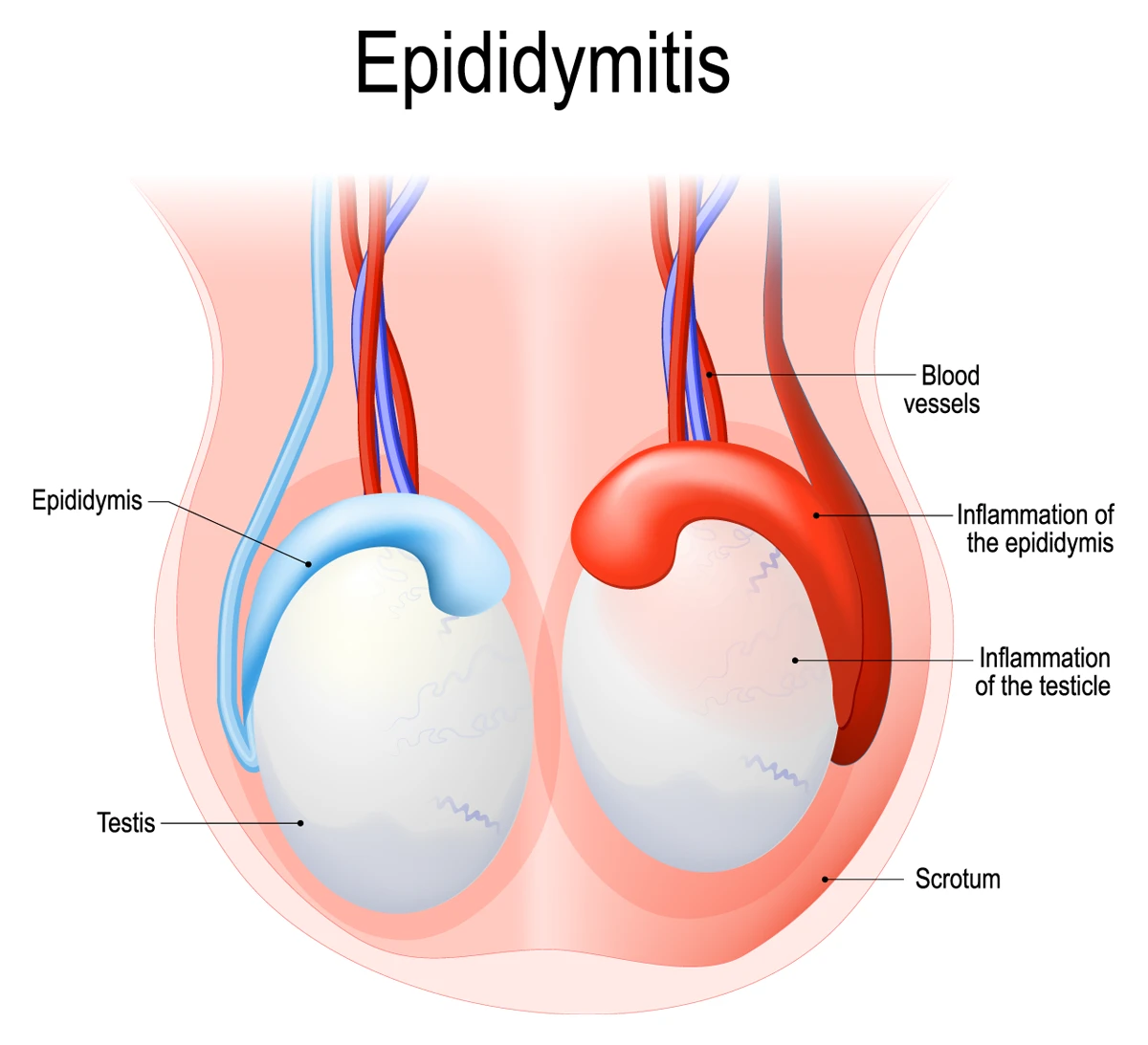 The photo shows epididymitis, the inflammation of the epididymis.