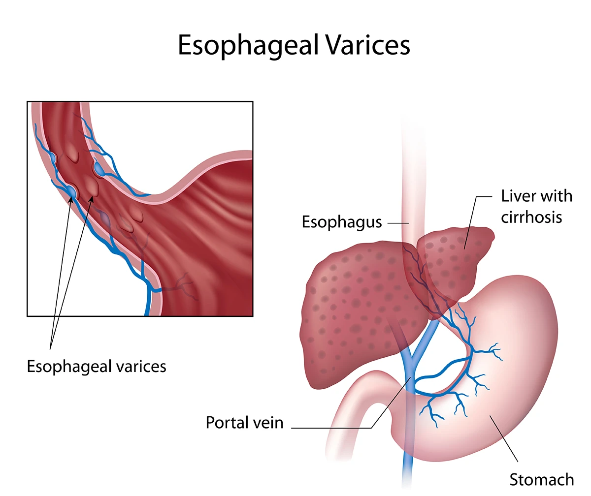 Blocked blood vessels around the esophagus