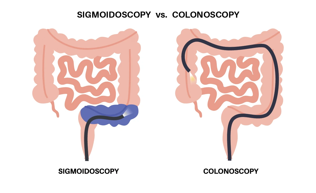 An image that shows the difference between sigmoidoscopy and colonoscopy