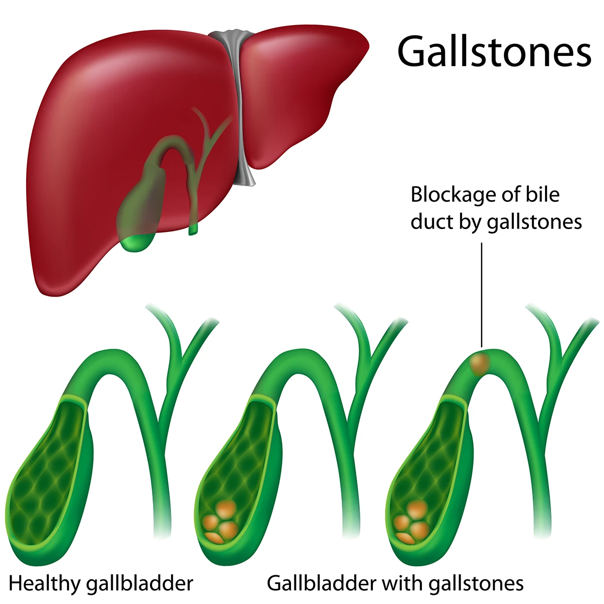 The image shows a healthy gallbladder compared to a gallbladder with gallstones and a gallstone blocking the bile duct.