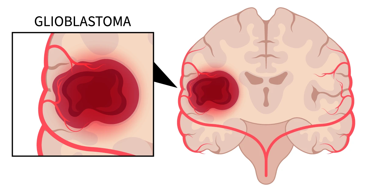 Image shows glioblastoma tumor in brain