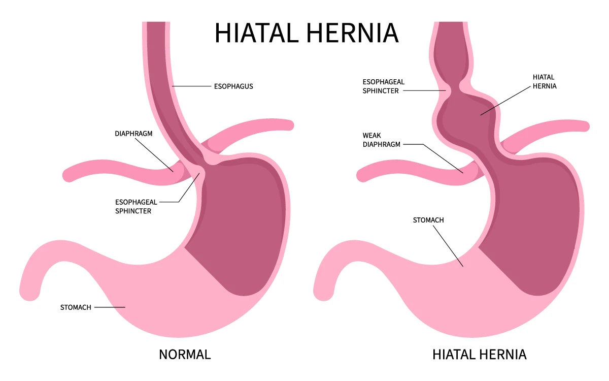 Normal stomach, diaphragm and esophagus vs. hiatal hernia