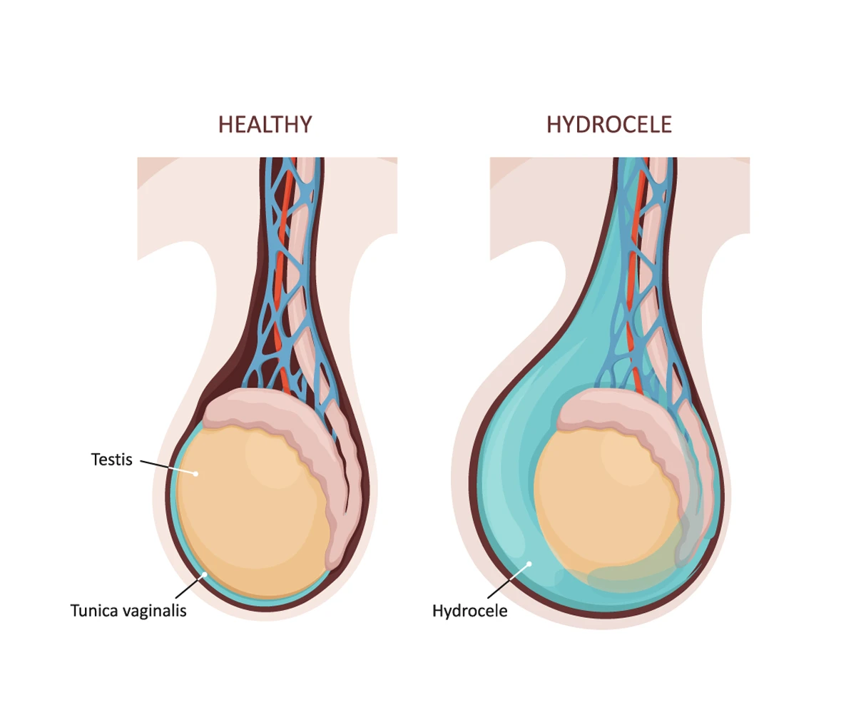 The image shows fluid buildup surrounding the testicle in the scrotum compared to a healthy testicle on the left.