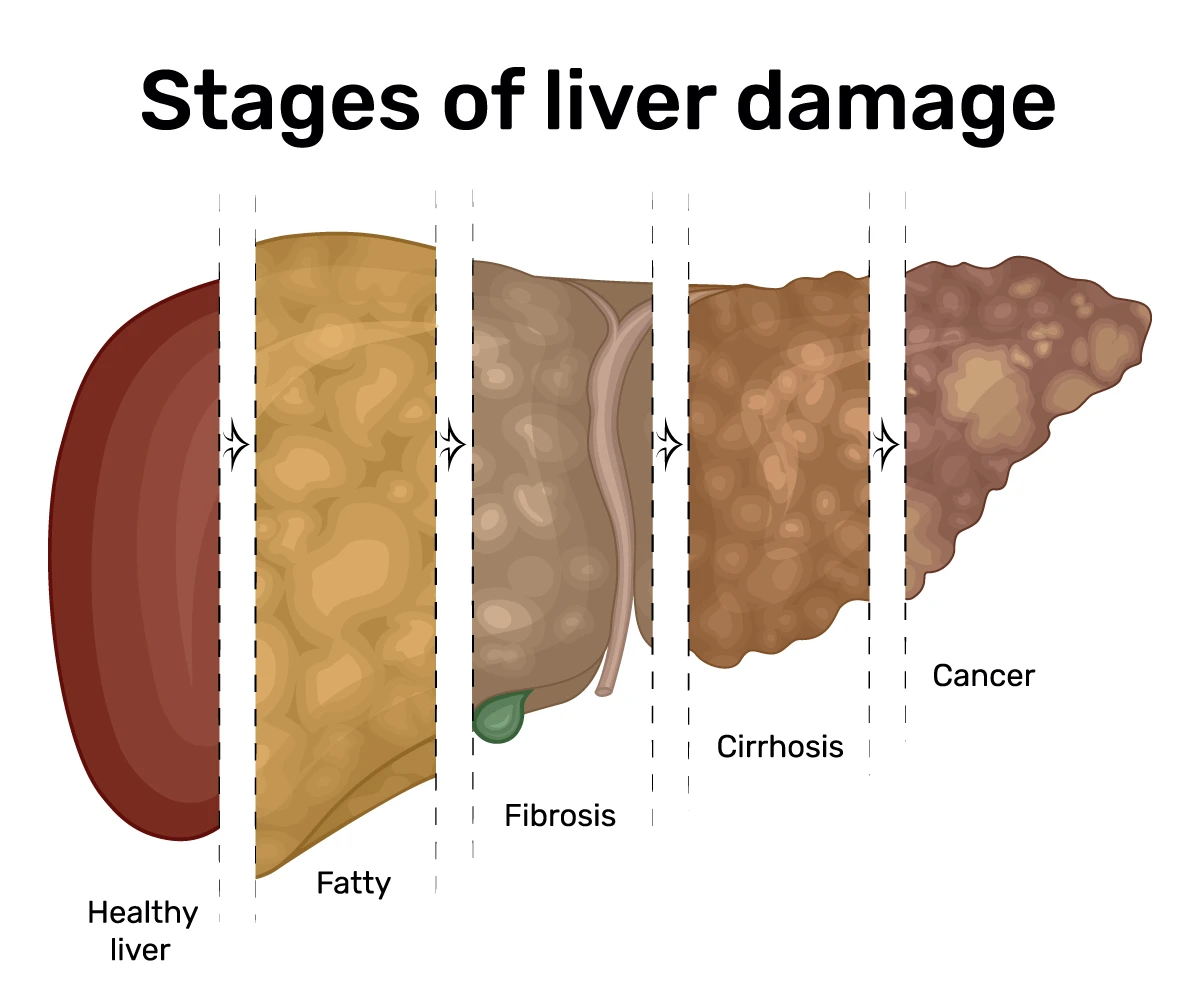 Image shows the four stages of liver disease