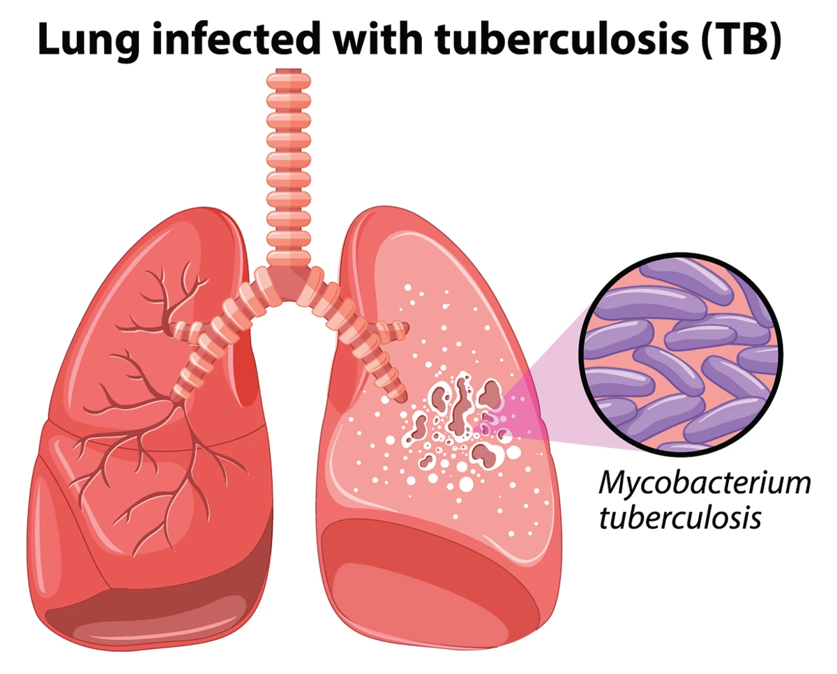 Lung infected with tuberculosis (TB)