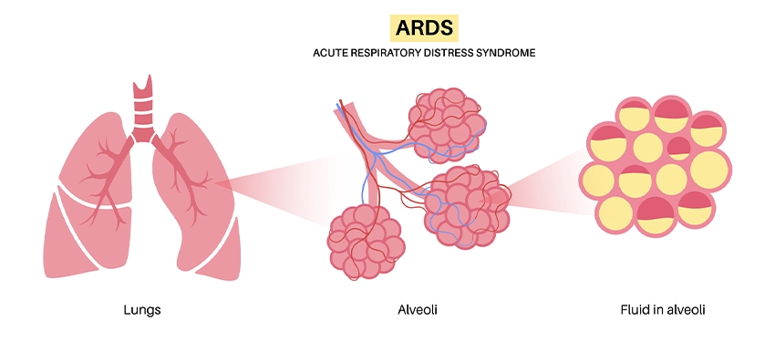 Lungs, alveoli and alveoli with fluid inside