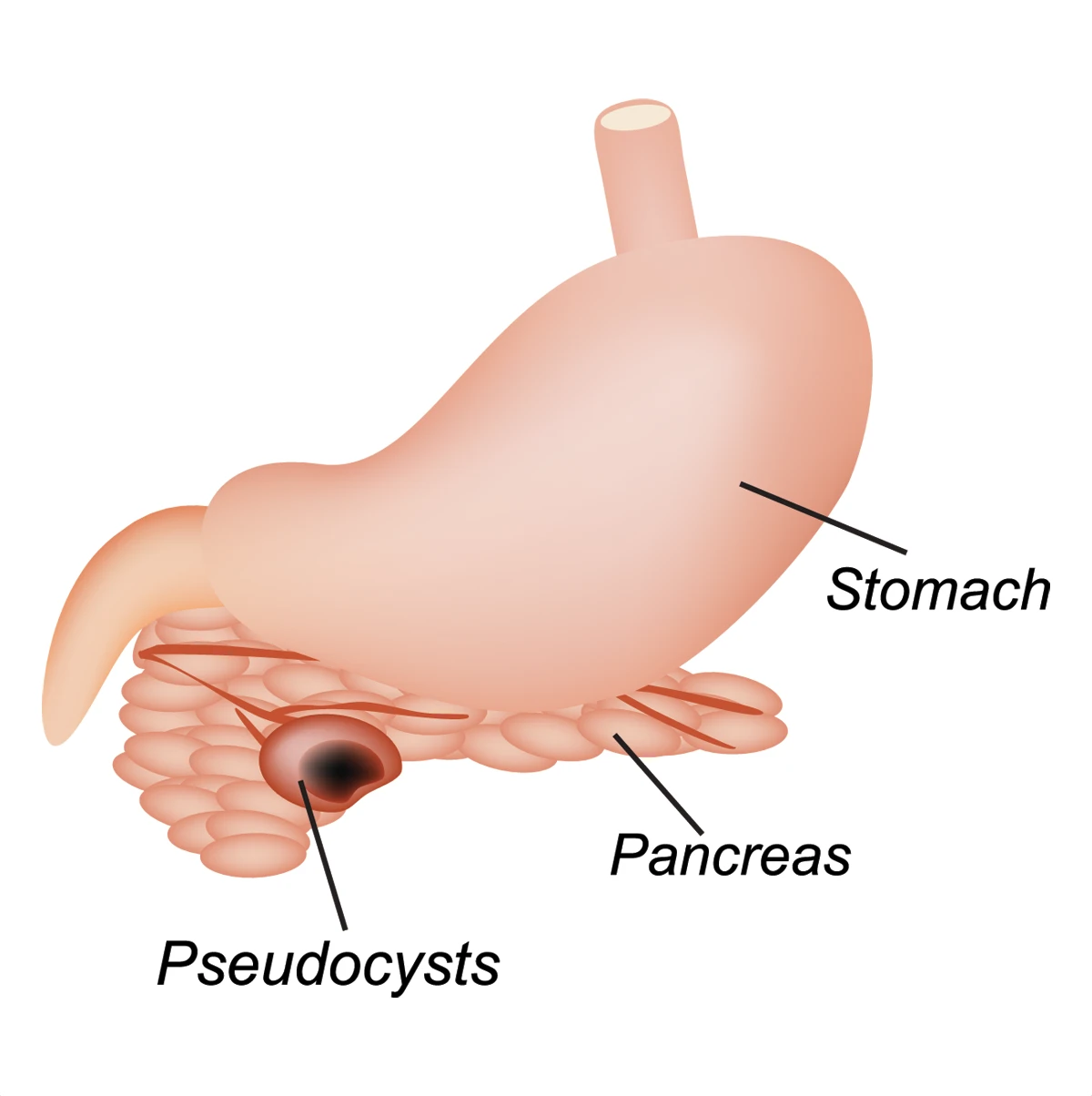 Pancreatic pseudocyst inside the pancreas, below the stomach.