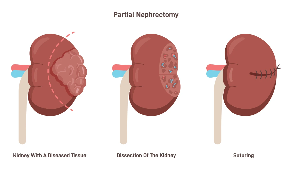 Partial removal of kidney to dissect cancerous tumors