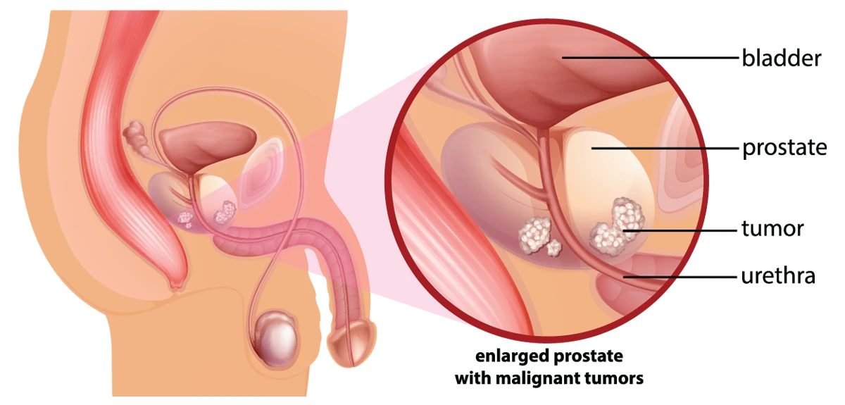 Enlarged prostate gland with cancerous tumors