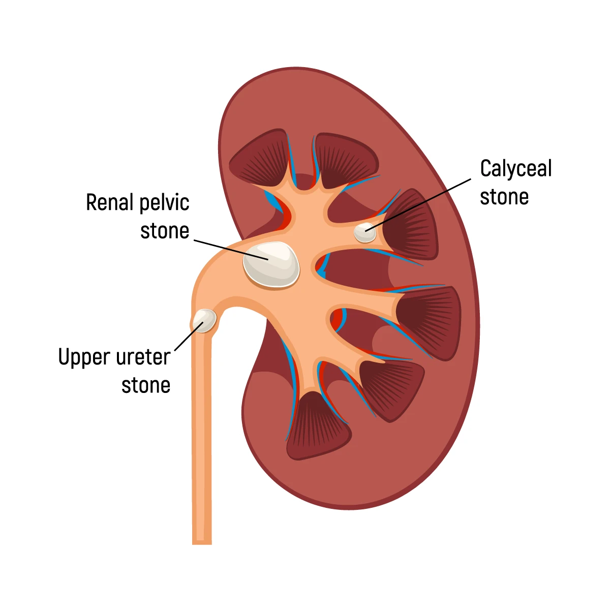 The image shows an upper ureter stone that has moved into the ureter from the kidney, along with a renal pelvic stone and a calyceal stone.