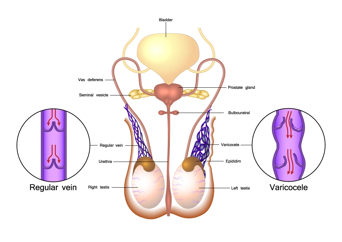 The image shows the difference between healthy veins in the scrotum and varicoceles.