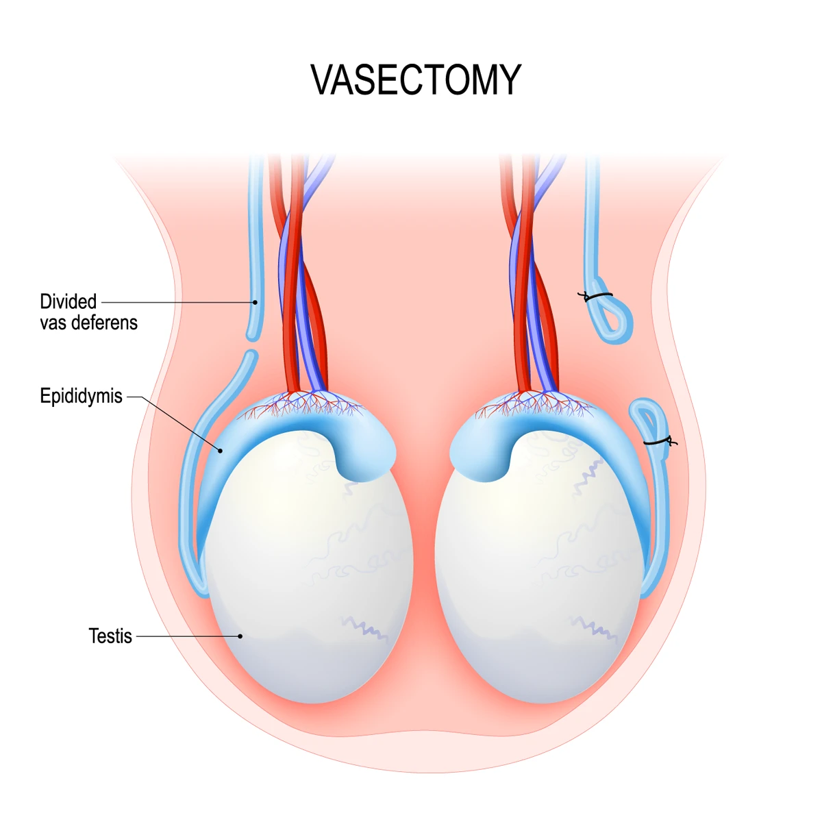 How the vas deferens is cut and tied off during a vasectomy.